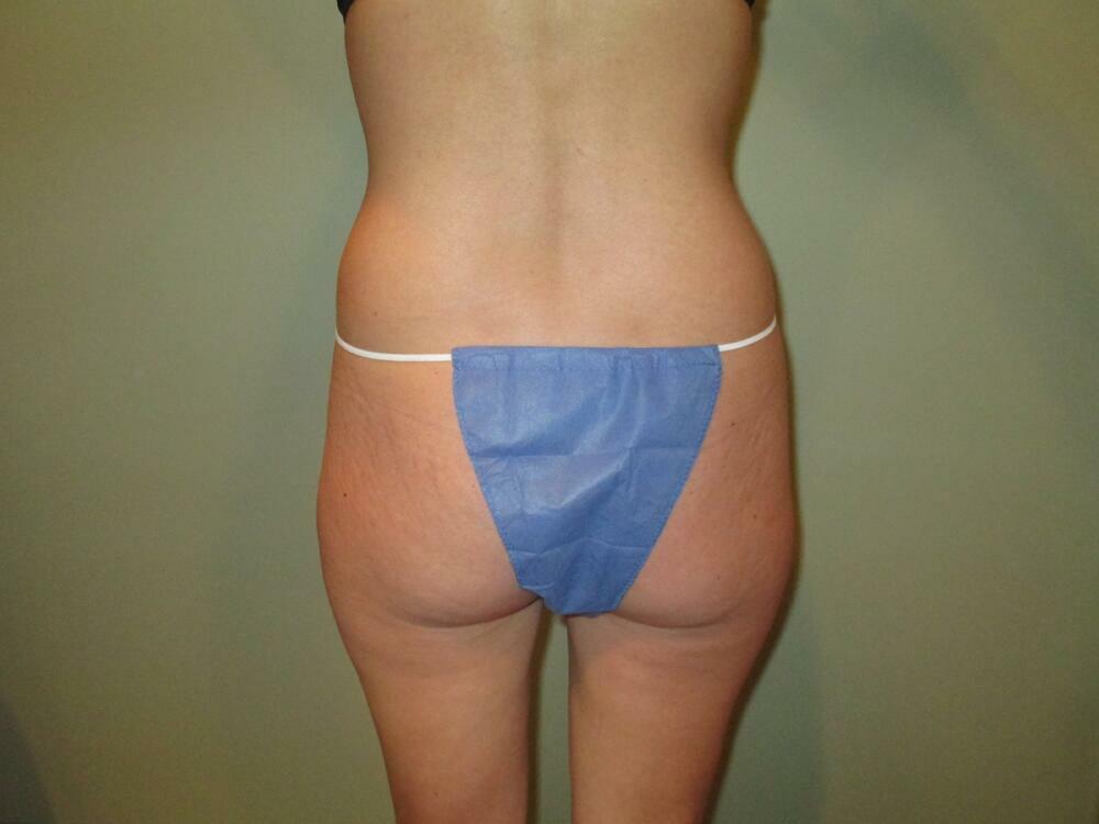 Tummy Tuck Before & After